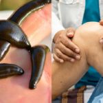 Amazing Benefit of Leech Therapy in Joint Pain.