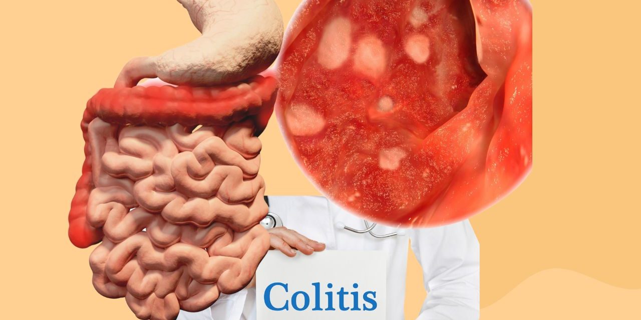 Understanding Colitis Symptoms and Treatment HerbTib Blog