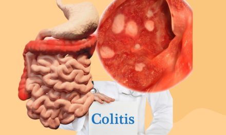 Understanding Colitis Symptoms and Treatment
