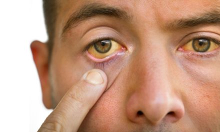 Jaundice: Understanding the Symptoms of Jaundice (Yellowing of the Skin and Eyes)