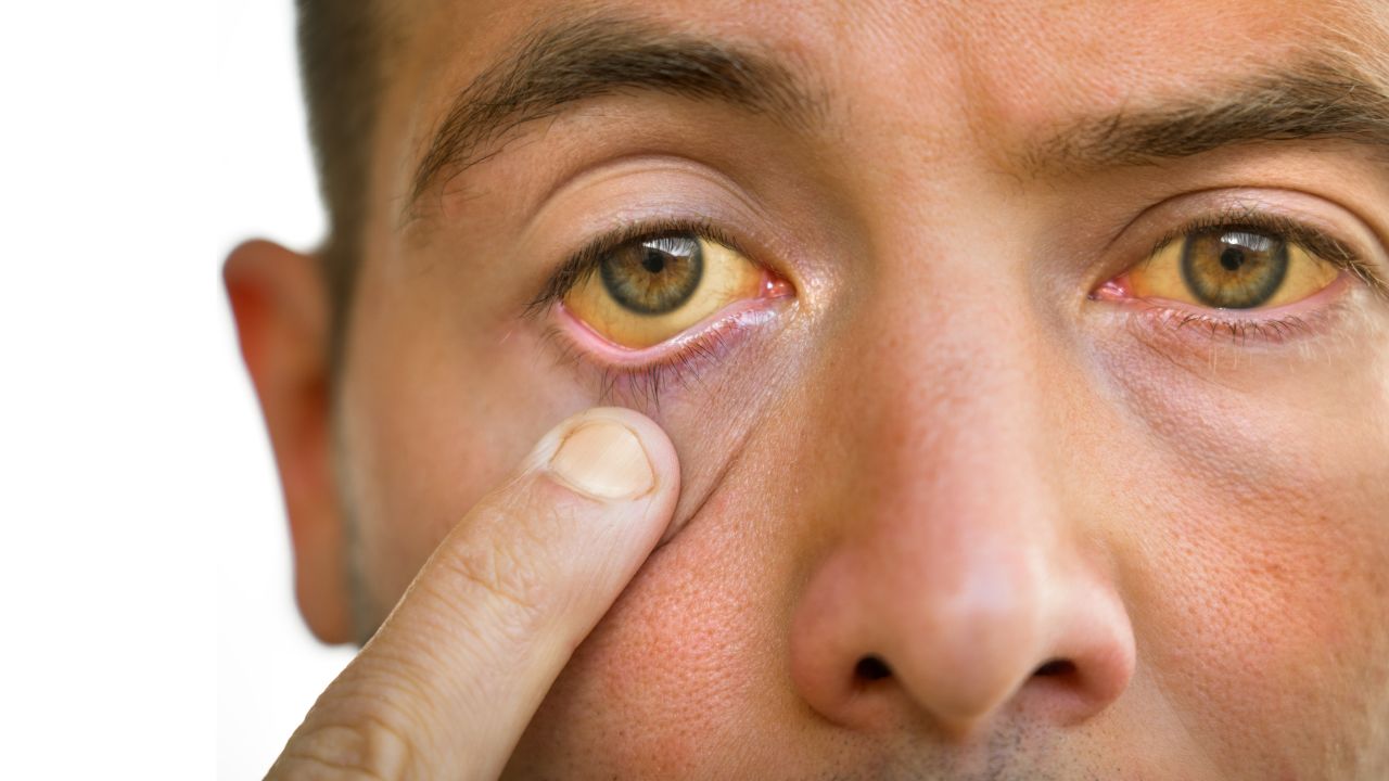 Jaundice Understanding the Symptoms of Jaundice (Yellowing of the Skin