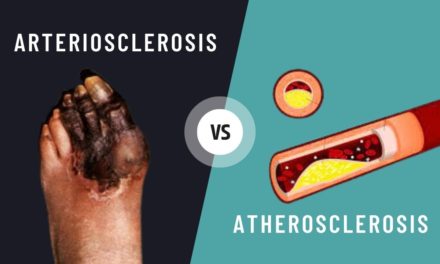Knowing About Arteriosclerosis / Atherosclerosis and its Treatment and Prevention
