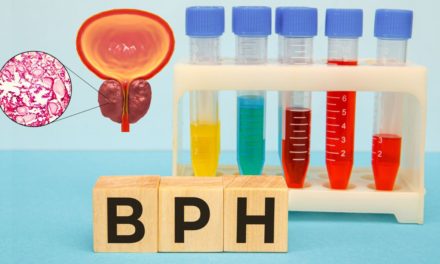 (BPH) Benign Prostatic Hyperplasia Disease and Best Treatment