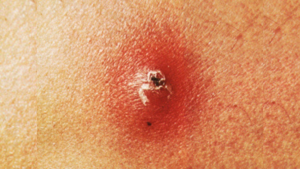 Carbuncle Disease and Best Treatment HerbTib Blog