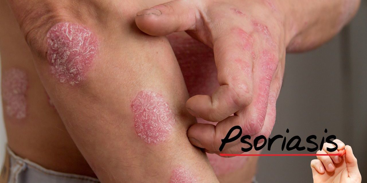 Nail Psoriasis: Overview of Nail Psoriasis, Pathophysiology of Nail  Psoriasis, Epidemiology of Nail Psoriasis